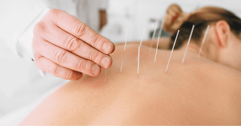 Acupuntura